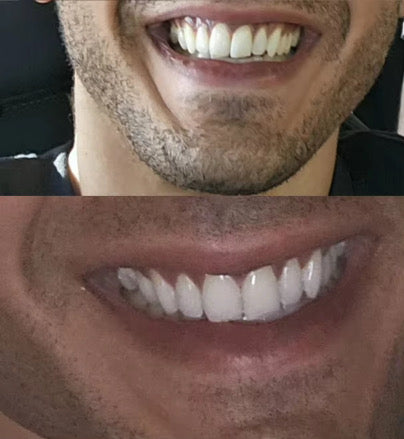 Kit blanqueamiento dental