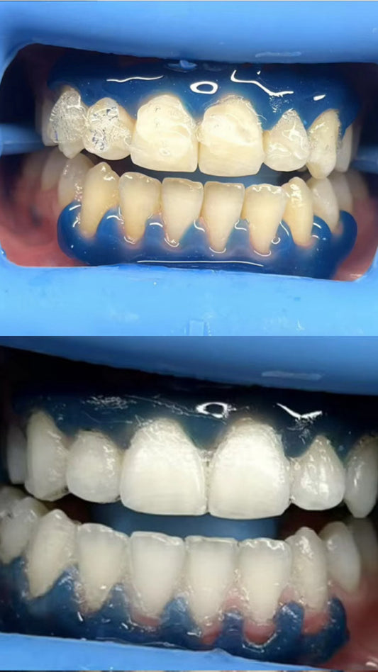 Kit blanqueamiento dental